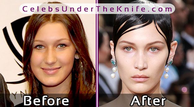 Bella Hadid’s Nose Job? Before After Photos Ready