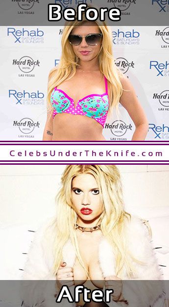 Chanel West Coast Boob Job Photos Before After