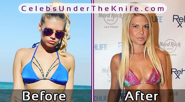 Chanel West Coast’s Breast Enhancements? 