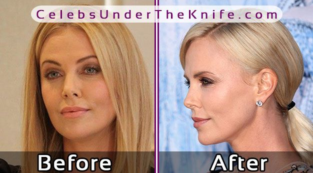 Charlize Theron Nose Job Before After Photos