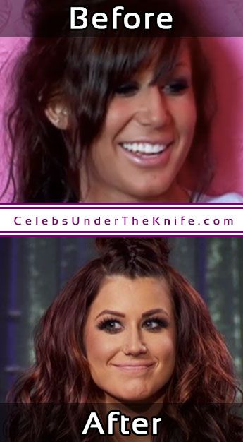 Chelsea Houska Nose Job Plastic Surgery Photos