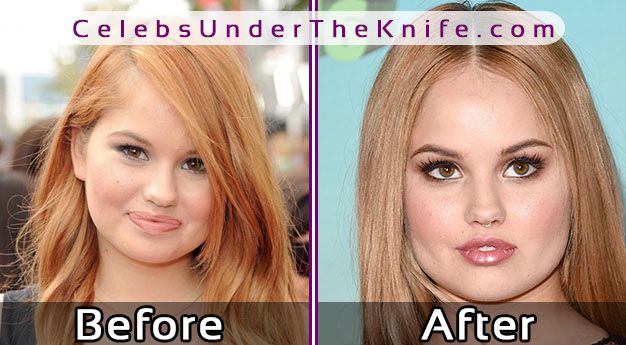 Debby Ryan Plastic Surgery Photos – Before + After