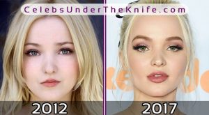 Dove Cameron 2017 Before After