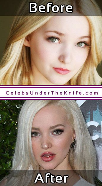 Dove Cameron Lip Injections Surgery Photos