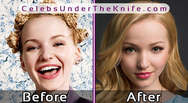 Dove Cameron Nose Job Before After