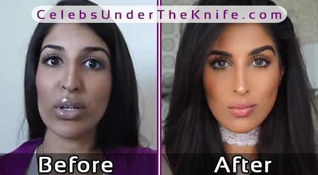 Farahdhukai Nose Job Photos Plastic Surgery