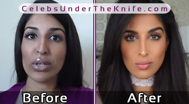 Farahdhukai (Youtube) Nose Job? Before + After Plastic Surgery Photos