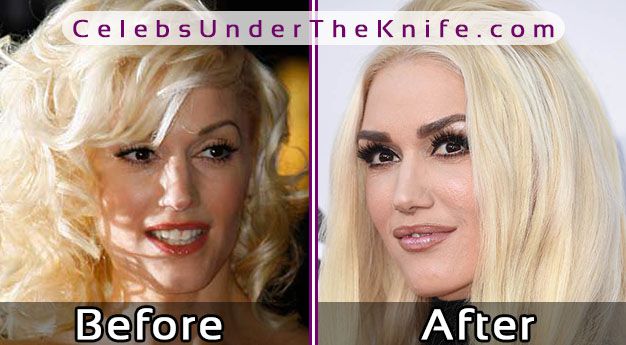 Gwen Stefani Before After Surgery Pics