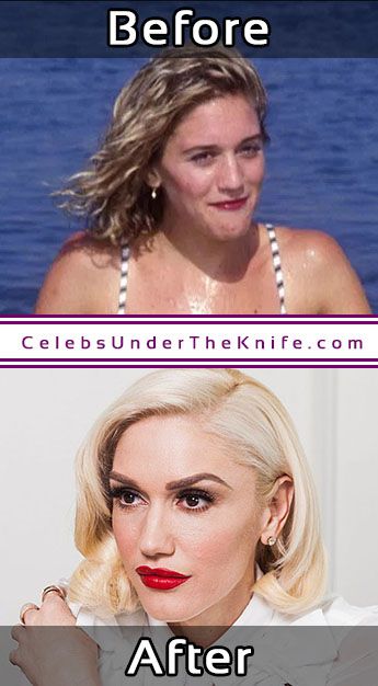 Gwen Stefani Then Now Plastic Surgeries