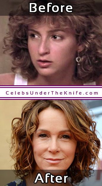 Jennifer Grey Nose Job Photos Before After