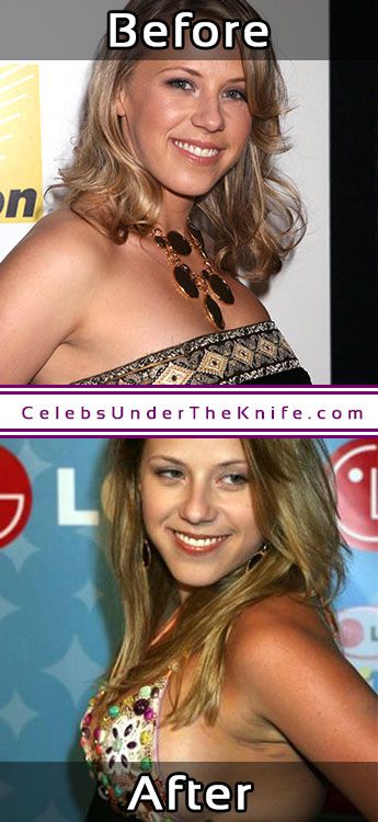Jodie Sweetin Breast Augmentation Results