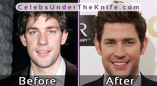 John Krasinski Nose Job Photos Before After