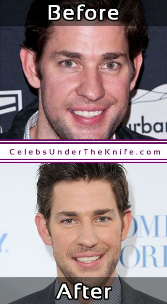 John Krasinski Plastic Surgery Photos