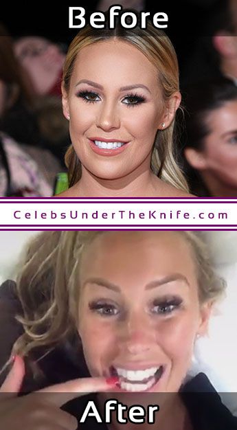 Kate Wright Photos Cosmetic Surgery