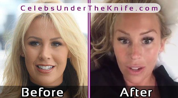 Kate Wright Plastic Surgery Photos Before After