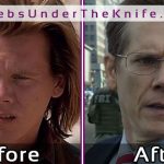 Kevin Bacon After Rhinoplasty   Cosmetic Procedure