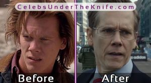 Kevin Bacon After Rhinoplasty   Cosmetic Procedure