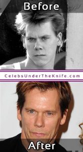 Kevin Bacon Nose Job Before After Surgery