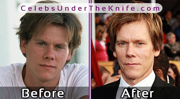 Kevin Bacon Plastic Surgery Pics