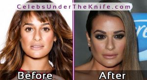 Lea Michele Cosmetic Procedure