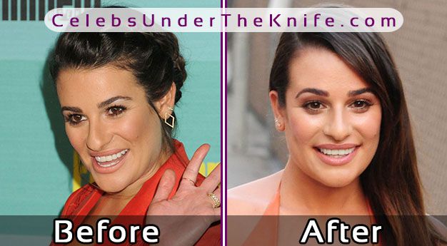 Lea Michele Plastic Surgery Photos