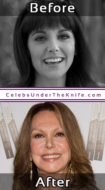 Marlo Thomas Nose Job Photos Plastic Surgery