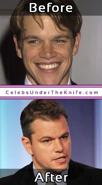 Matt Damon Cosmetic Procedure Rhinoplasty