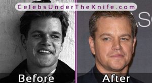 Matt Damon Nose Job Photos
