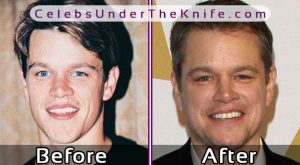 Matt Damon Plastic Surgery Before After Pics