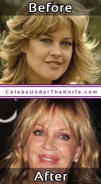 Melanie Griffith Cosmetic Surgery Photos