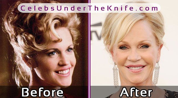 Melanie Griffith Plastic Surgery Before After Photos