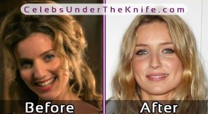 Annabelle Wallis Before After Plastic Surgery