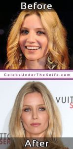 Annabelle Wallis Cosmetic Procedure Results