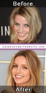 Annabelle Wallis Rhinoplasty Before After Pics