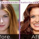 Debra Messing Nose Job Before After