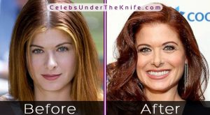 Debra Messing Nose Job Before After