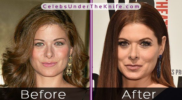 Debra Messing Photos Plastic Surgery