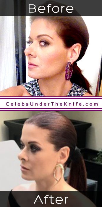 Debra Messing Rhinoplasty Results