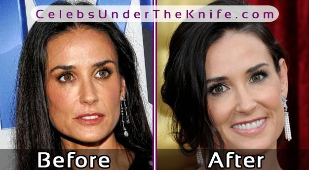 Demi Moore Before After Surgery
