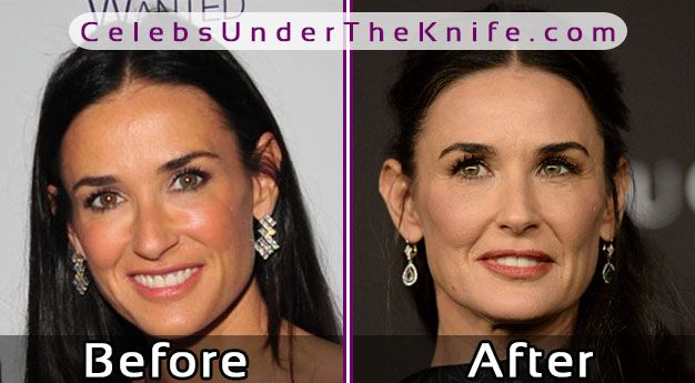 Demi Moore Cosmetic Procedure Photos