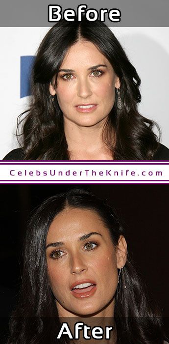 Demi Moore Nose Job Pics