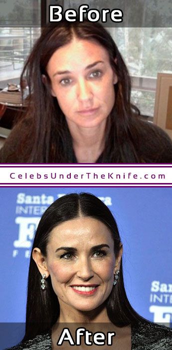 Demi Moore Plastic Surgery Results