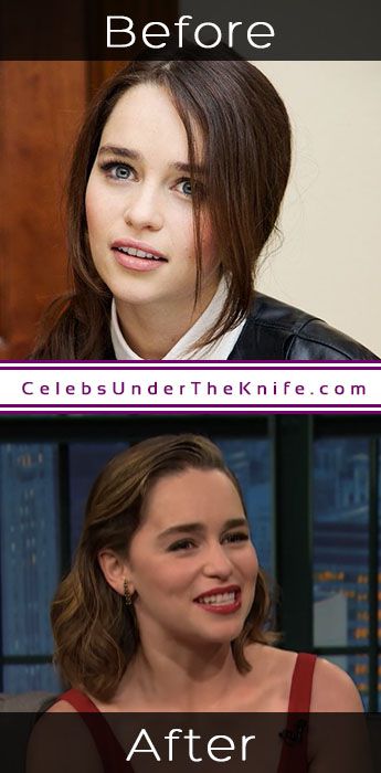 Emilia Clarke Before Going Under The Knife