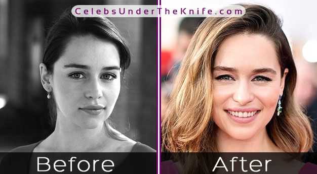 Emilia Clarke Before and After Photos