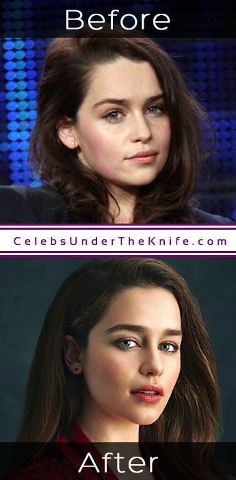 Emilia Clarke Cosmetic Procedure Results