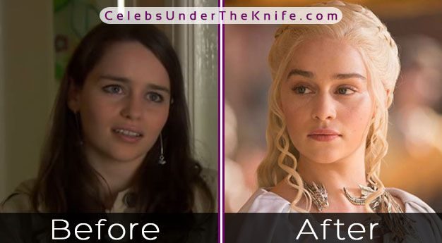 Emilia Clarke Plastic Surgery Rumors