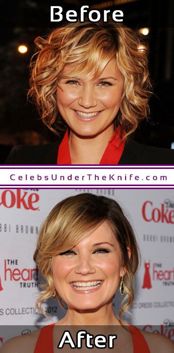 Jennifer Nettles Nose Job Procedure Results