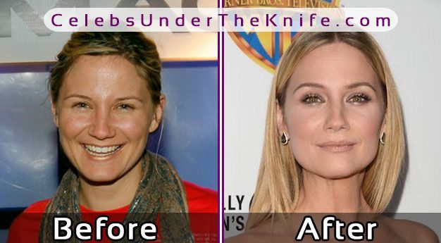 Jennifer Nettles Plastic Surgery