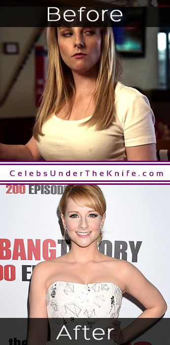 Melissa Rauch Plastic Surgery Results