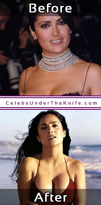 Salma Hayek Before After Photos Cosmetic Procedure